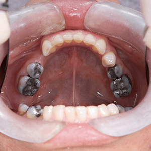 Schwermetalle - in Zahnfüllungen.